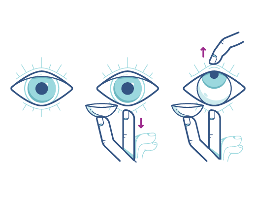 Mit der folgenden Technik können Sie Ihre Augen beim Einsetzen der Kontaktlinsen geöffnet halten.