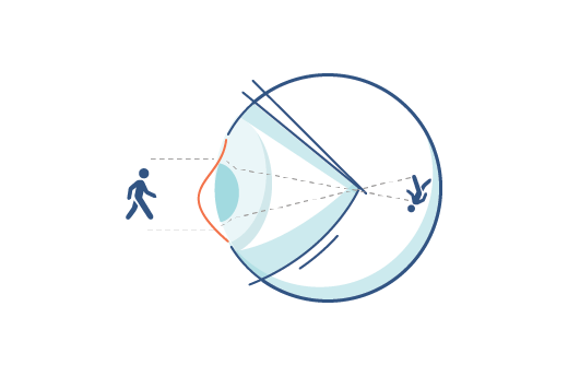 Illustration d'un œil atteint d'astigmatisme