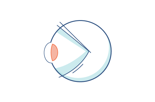 Illustration eines Auges mit Presbyopie