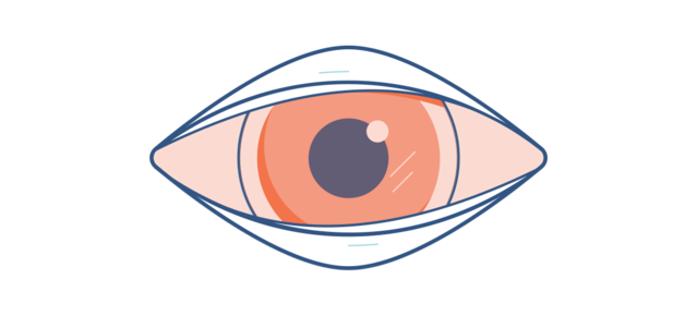 Illustration eines entzündeten Auges