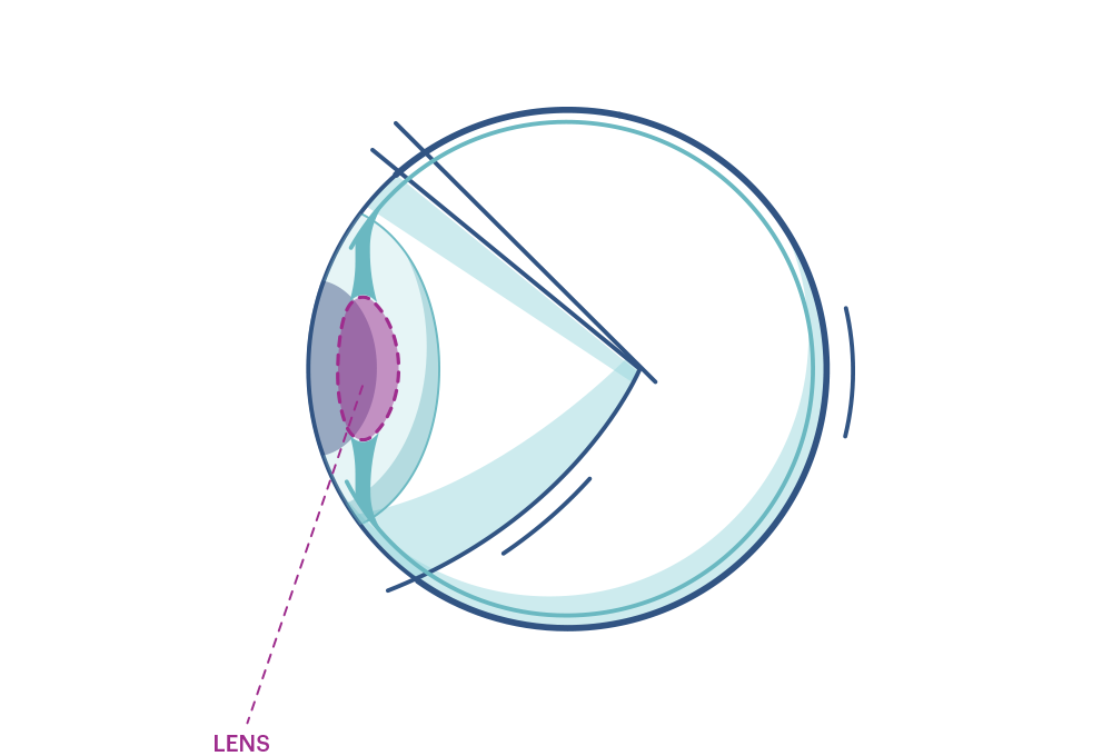 Illustration eines Auges mit Makierung der Linse 