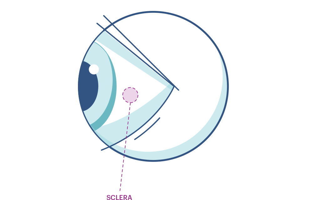 Illustration eines Auges mit Markierung der Lederhaut