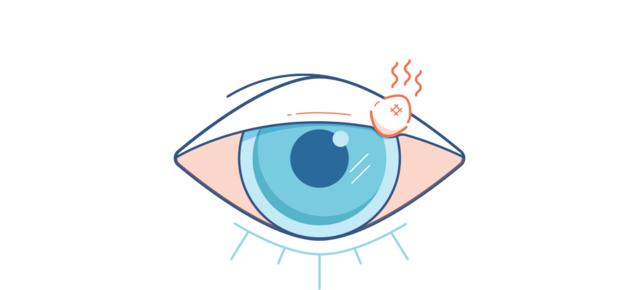 Illustration eines Gerstenkorns am Augenlid.
